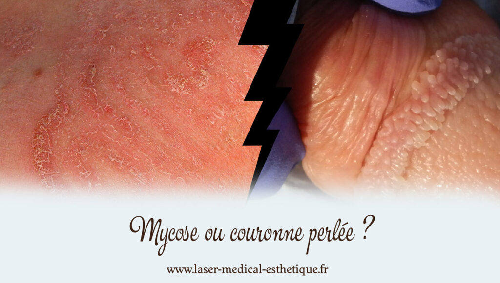 Mycose ou couronne perlée ? Mycose ou couronne perlée