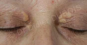 Plexr pour xanthelasma