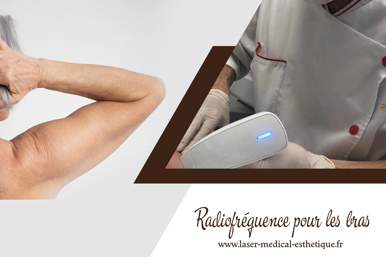 Radiofréquence pour les bras Radiofréquence pour les bras