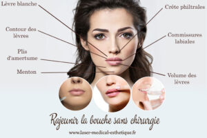 Rajeunir la bouche sans chirurgie