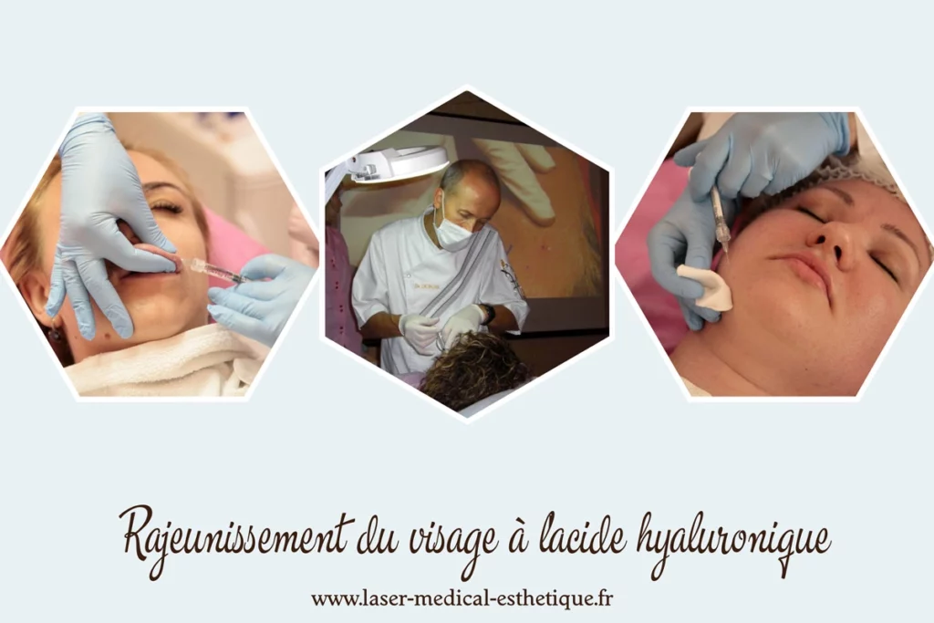 Rajeunissement du visage à l'acide hyaluronique