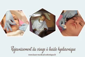 Rajeunissement du visage à l'acide hyaluronique