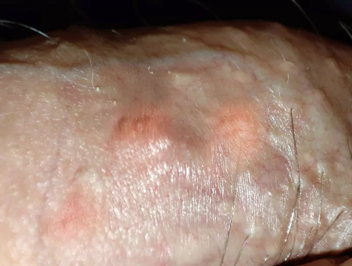 Réactions allergiques sur le pénis