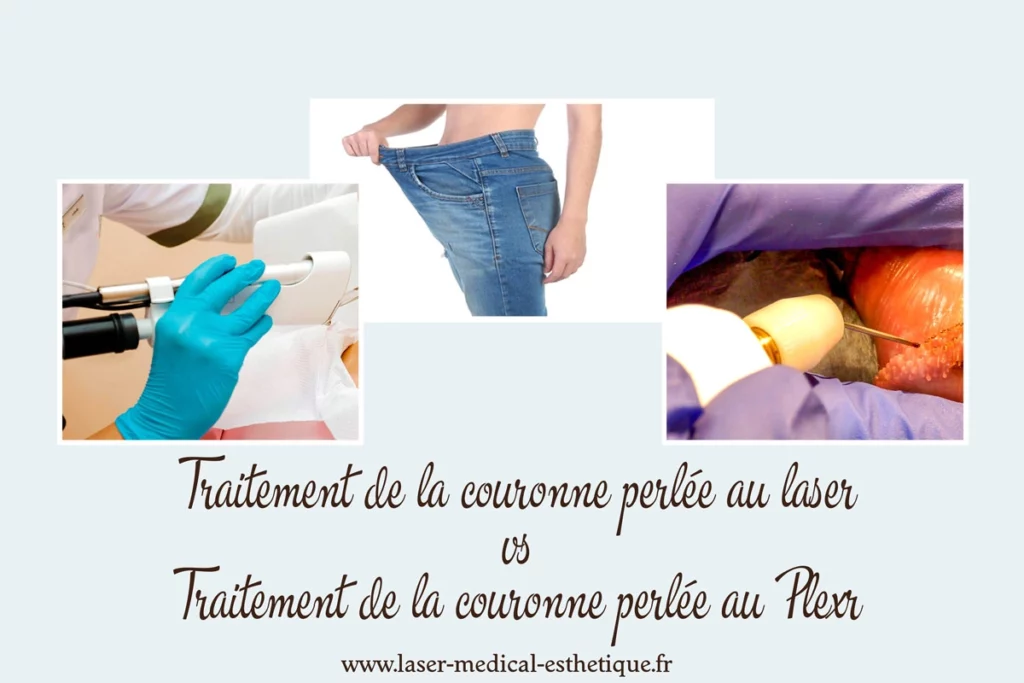 Traitement de la couronne perlée au laser ou au Plexr ? Traitement de la couronne perlée au laser ou plexr