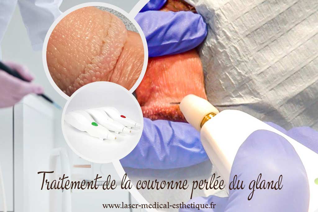 Traitement de la couronne perlée du gland Traitement de la couronne perlée du gland