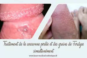 Traitement des papules perlées du gland Traitement de la couronne perlée et des grains de Fordyce