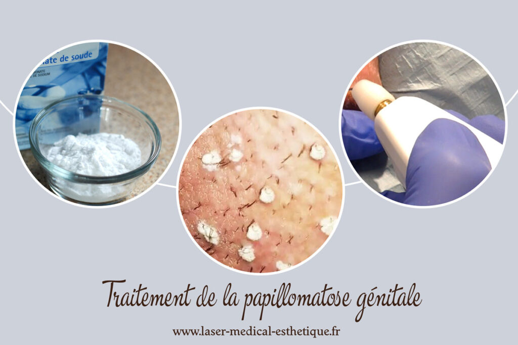 Traitement de la papillomatose génitale Traitement de la papillomatose génitale