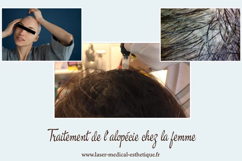 Traitement de l’alopécie chez la femme Traitement de l’alopécie chez la-femme