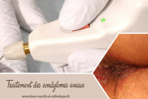 Traitement des condylomes anaux