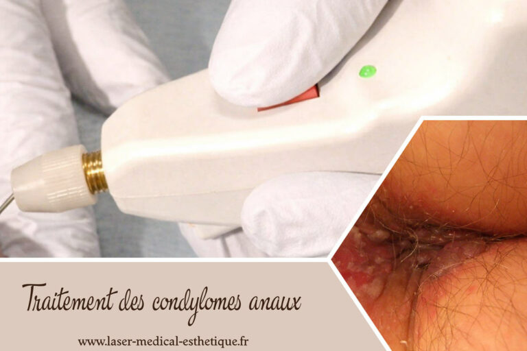 Traitement des condylomes anaux