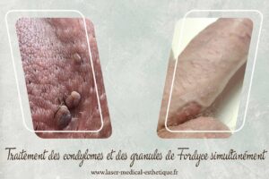 Traitement des condylomes et des granules de Fordyce simultanément