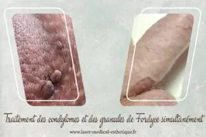 Dépôts de cholestérol dans les yeux : traitements et causes Traitement des condylomes et des granules de Fordyce simultanément
