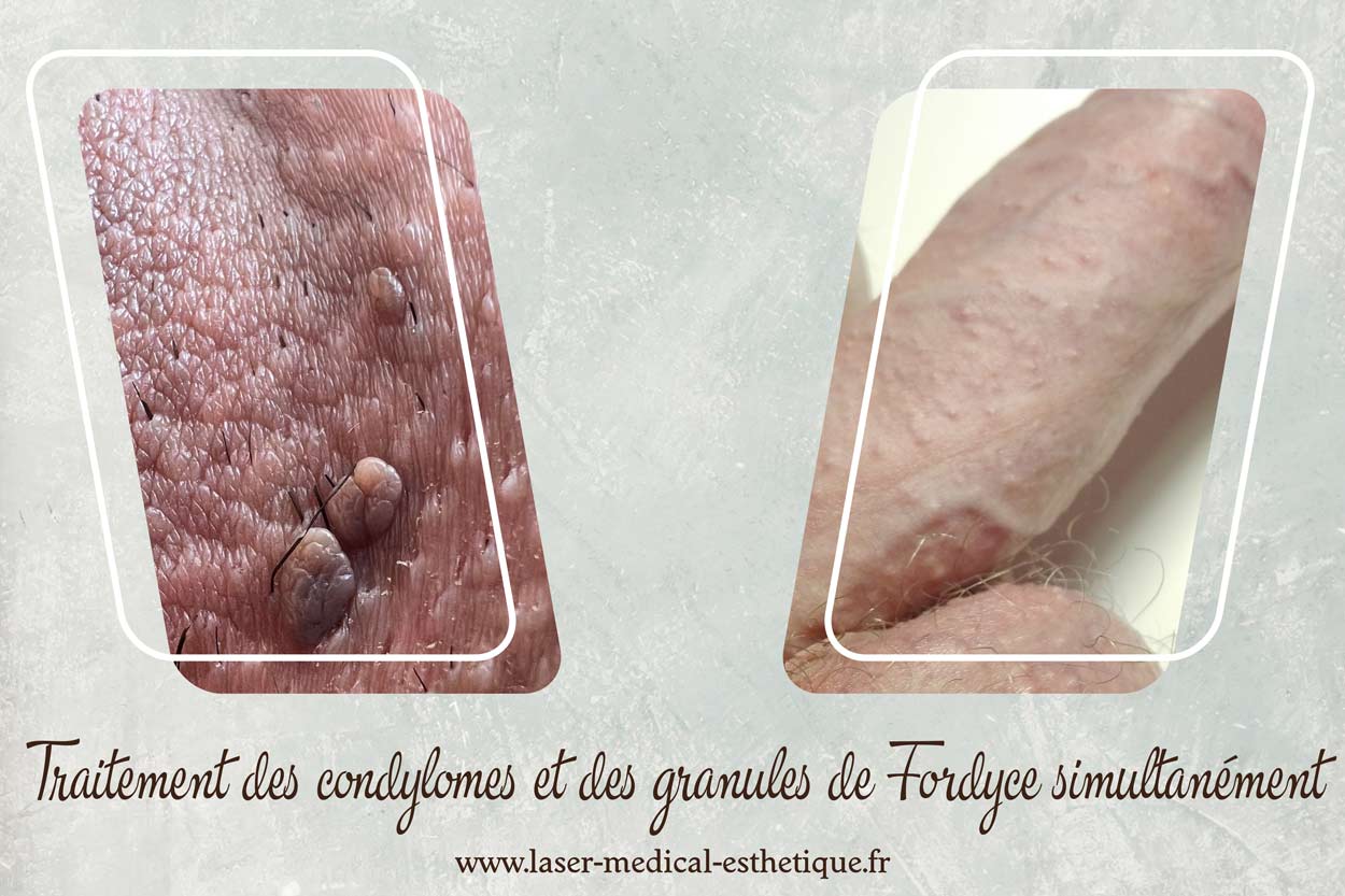 Traitement des condylomes et des granules de Fordyce simultanément