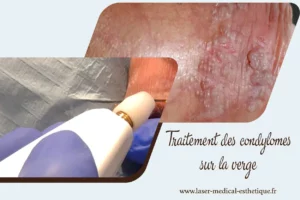 Couronne perlée ou verrues génitales ? Traitement des condylomes sur la verge