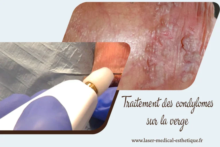 Traitement des condylomes sur la verge