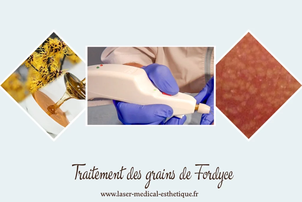 Traitement des grains de Fordyce Traitement des grains de Fordyce