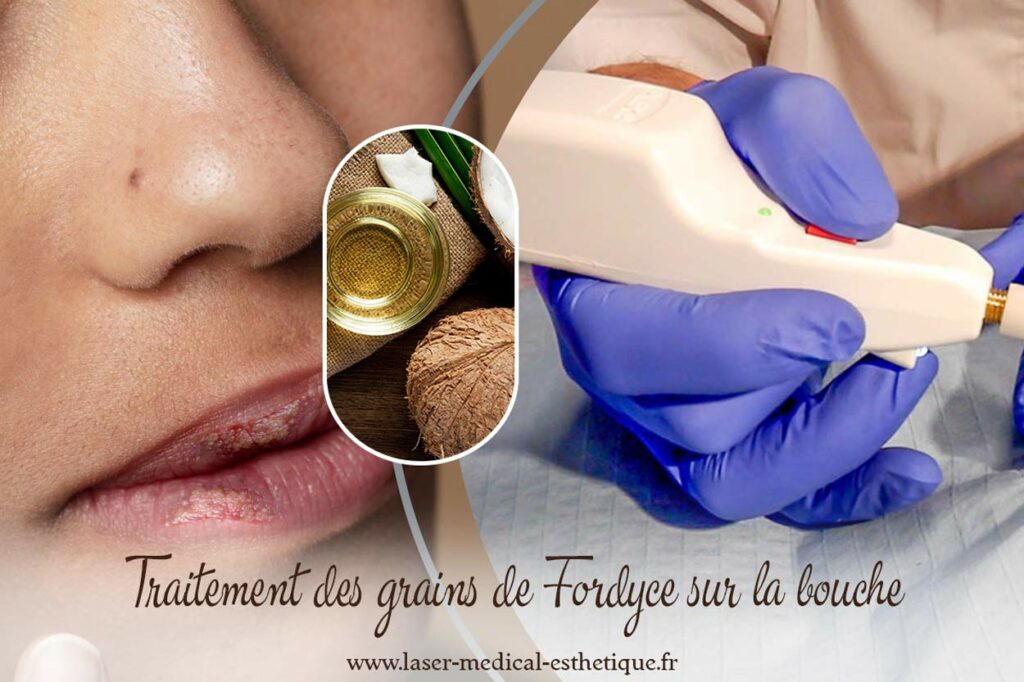 Traitement des grains de Fordyce sur la bouche