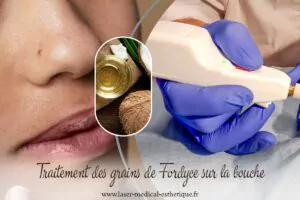 Traitement des grains de Fordyce sur la bouche