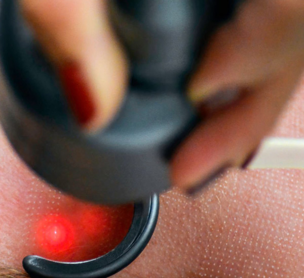 Traitements des grains de Fordyce sur la vulve Traitement des grains de Fordyce vulvaires avec le laser CO₂