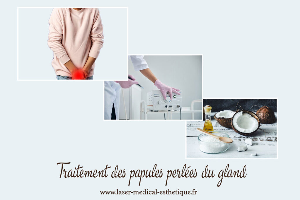 Traitement des papules perlées du gland Traitement des papules perlées du gland