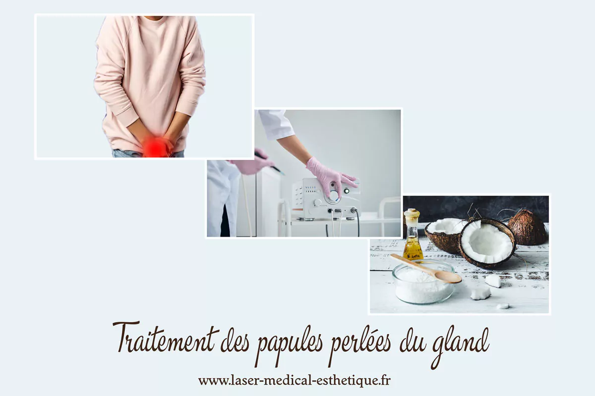 Traitement des papules perlées du gland Traitement des papules perlées du gland