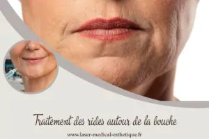 8 bienfaits surprenants de l’acide hyaluronique Traitement des rides autour de la bouche