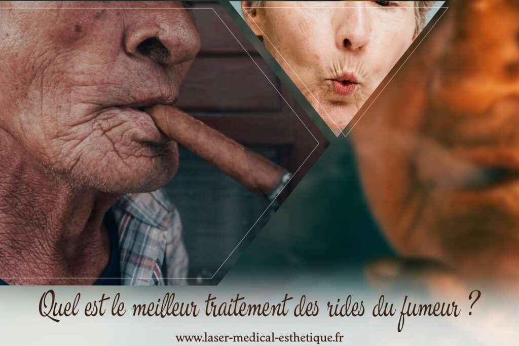 Quel est le meilleur traitement des rides du fumeur ? Traitement des rides du fumeur