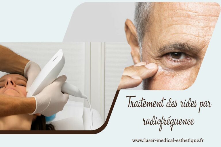 Centre Laser Médical Esthétique - Dr Didier Dubois à Angers Traitement des rides par radiofréquence