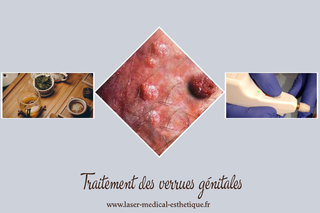 Traitement des verrues génitales (condylomes) Traitement des verrues génitales (condylomes)