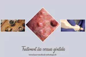 Traitement de la couronne perlée chez la femme Traitement des verrues génitales (condylomes)