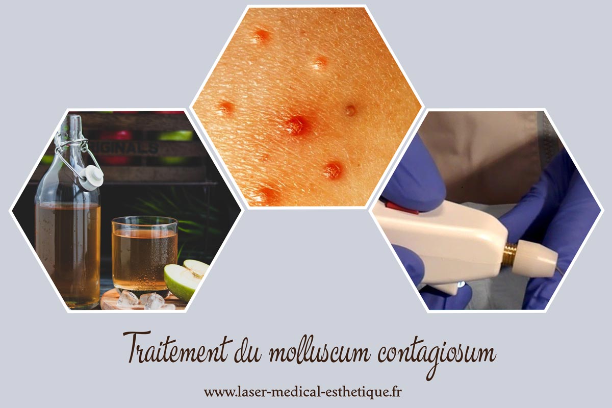 Traitement du molluscum contagiosum du glandTraitement du molluscum contagiosum du gland