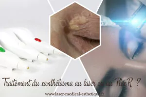 Boutons sur le pénis ou le gland du pénis : causes, diagnostic et traitement Traitement du xanthélasma au laser ou PlexR