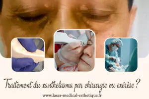 Boutons sur le pénis ou le gland du pénis : causes, diagnostic et traitement Traitement du xanthelasma par chirurgie ou exérèse