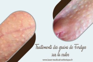 Traitements des grains de Fordyce sur la vulve