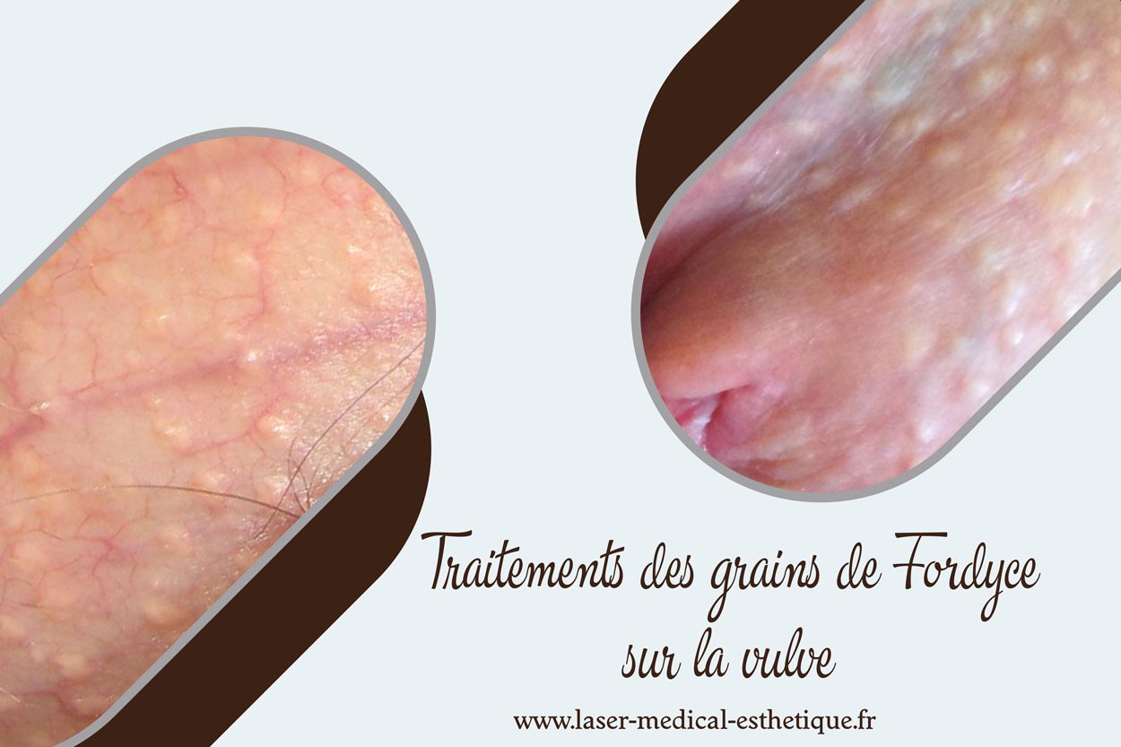 Traitements des grains de Fordyce sur la vulve Traitements des grains de Fordyce sur la vulve