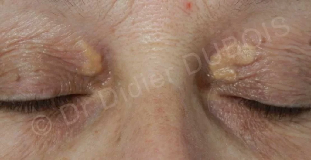 Xanthélasma : traitement non chirurgical par Plexr Xanthelasma