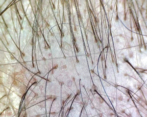 analyse des cheveux au fort grossissement