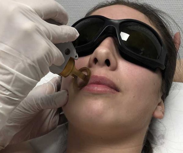 Epilation laser des lèvres du visage