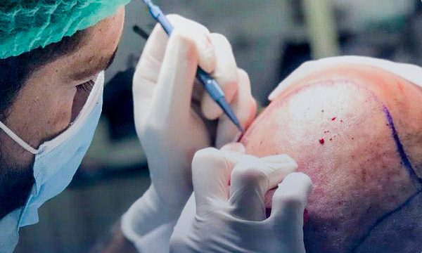 Greffe de cheveux FUE