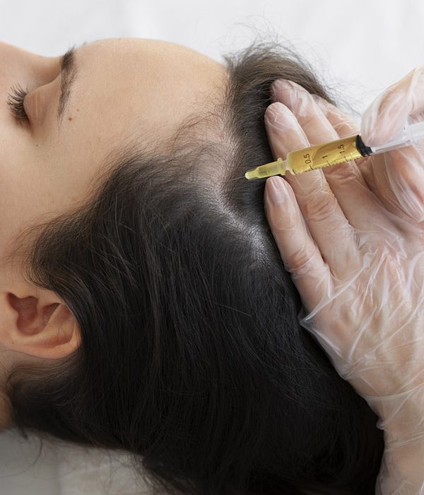 Solutions injectées lors d’une séance de mésothérapie capillaire