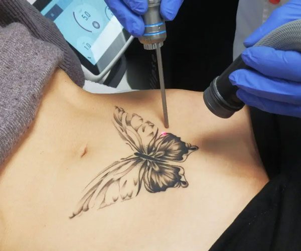 Suppression d'un tatouage au laser