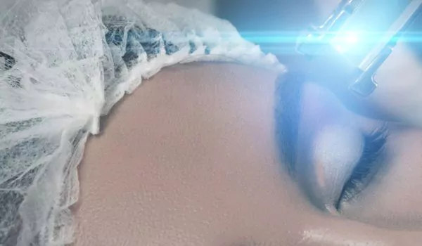 Traitement du xanthélasma au laser Traitement du xanthélasma au laser