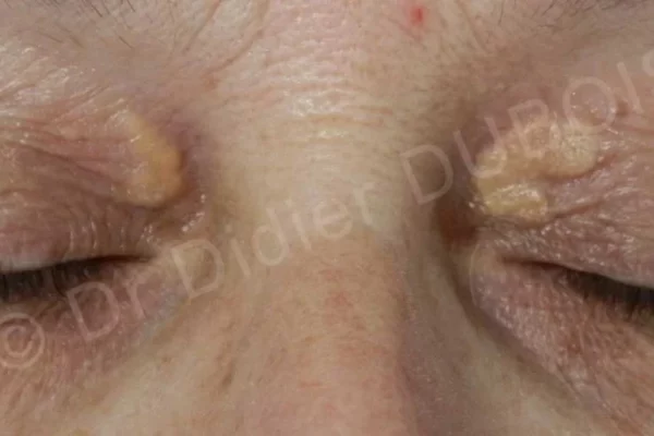 Xanthelasma