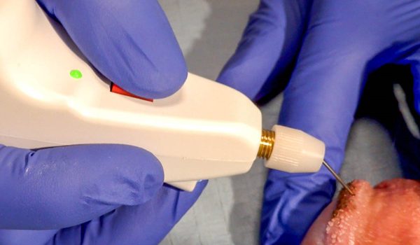 élimination des papules par plexr
