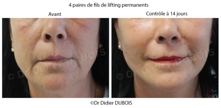 lifting visage aux fils photos avant après