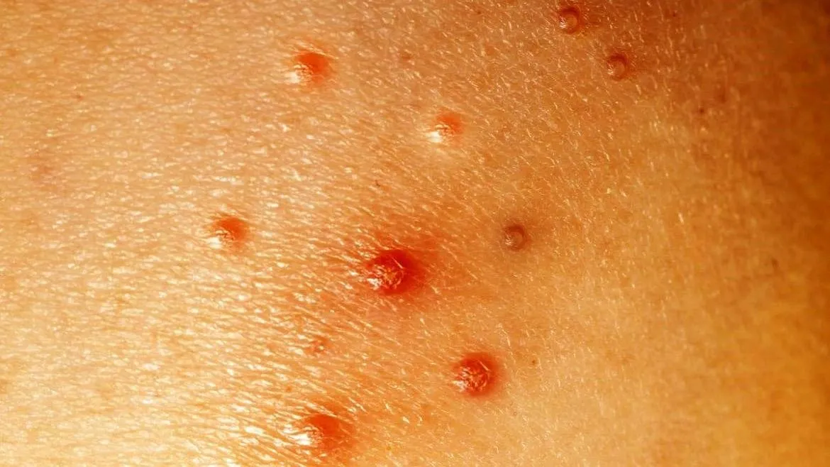 Traitement du molluscum contagiosum du gland