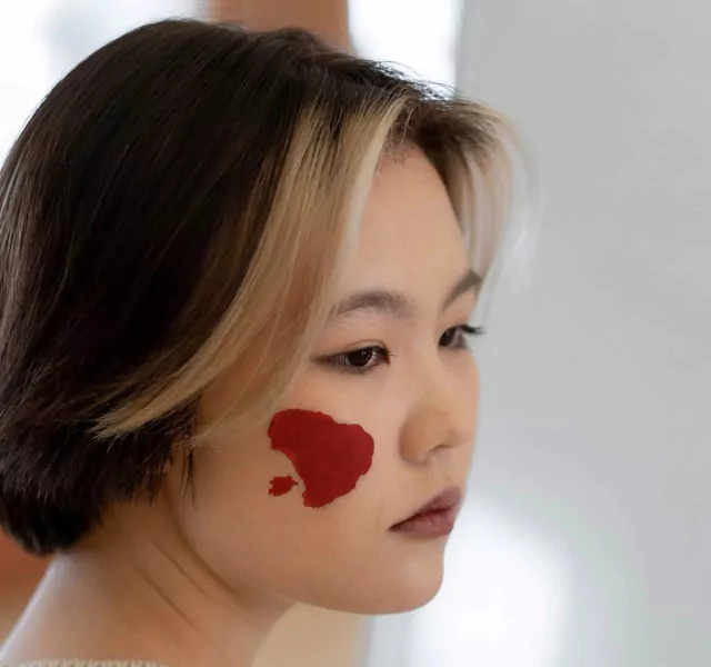 tache rubis localisée sur le visage d'une patiente