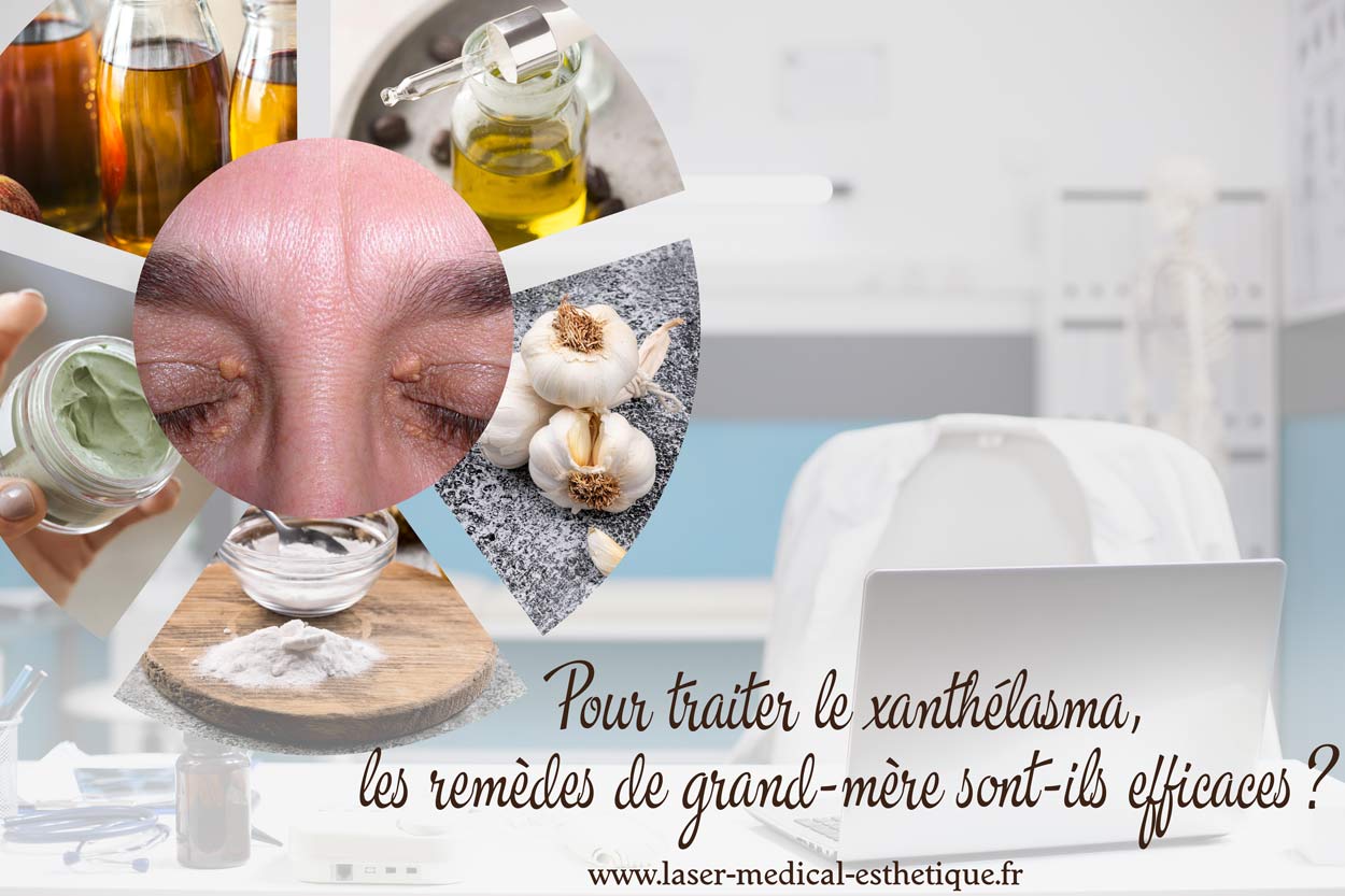 Pour traiter le xanthélasma, les remèdes de grand-mère sont-ils efficaces ? xanthélasma remèdes de grand-mère
